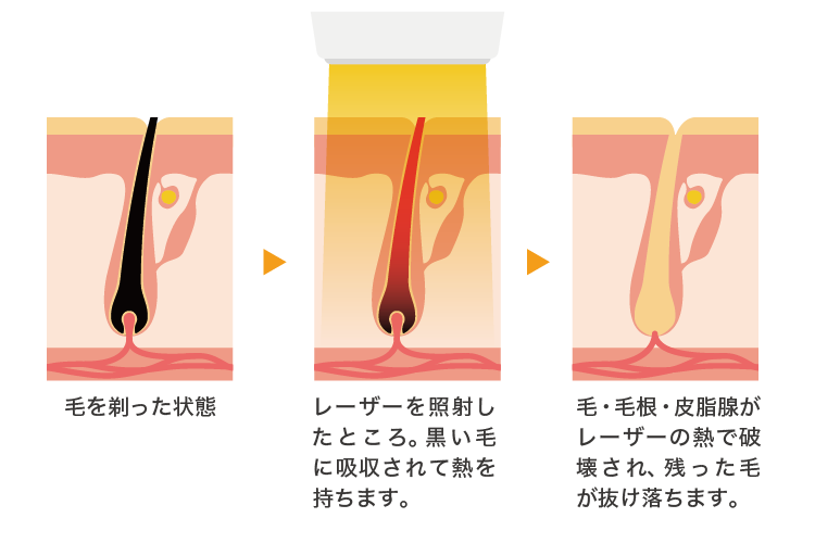 医療レーザー脱毛の仕組み