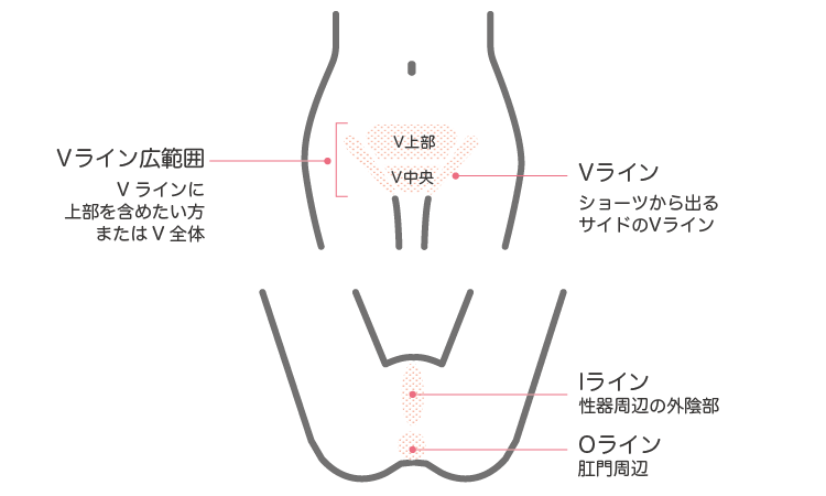 医療レーザー脱毛部位