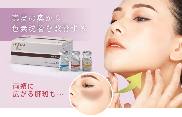 リバースピール