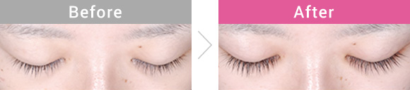 まつ毛貧毛症治療薬 グラッシュビスタ症例